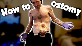 CHANGING MY OSTOMY BAG [upl. by Eduam222]