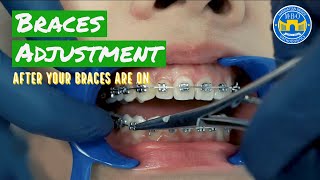 How Do Braces Straighten Teeth [upl. by Ahsikahs757]