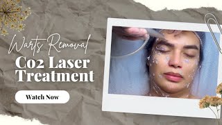 Warts Removal via Carbon Laser Treatment [upl. by Gnoud]