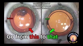 Removal of a phakic lens and then cataract surgery with a toric IOL [upl. by Giff323]