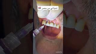 Caries removal and rehabilitation of the tooth phonk remix music genshinimpact asmrdentist [upl. by Serg]