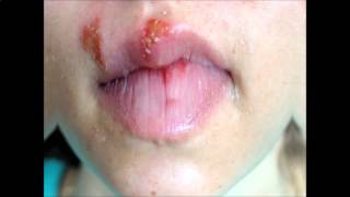 Herpes Cure  Get Rid Of Herpes [upl. by Matty724]