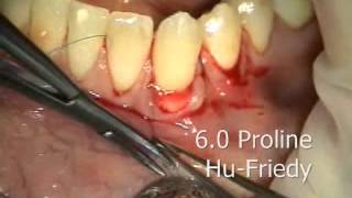 Periodontal Microsurgery AlloDerm Grafting Lower Anterior [upl. by Oznecniv269]