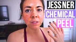 NIKKI GETS A NEW FACE Jessner Chemical Peel Review Before and After [upl. by Aralk]