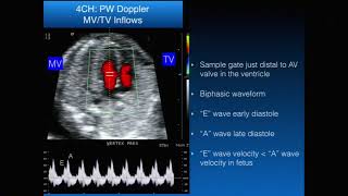 Basic Fetal Echocardiography [upl. by Yart380]