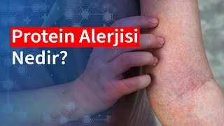 Protein Alerjisi Nedir  Medical Park [upl. by Orecic]