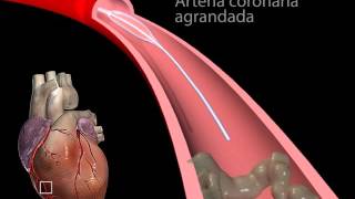 Angioplastia con balón segmento corto  Medicina y Cirugia [upl. by Atteyek]