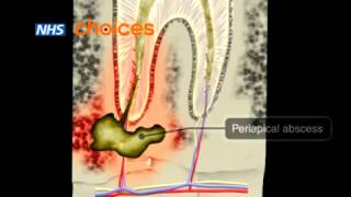 Dental abscess an animation [upl. by Kered]