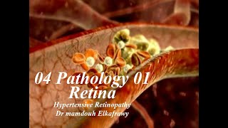 04 Retinal Pathology 01 Elkafrawy pathology باثولوجي الكفراوي Hypertensive Retinopathy [upl. by Teodoro189]