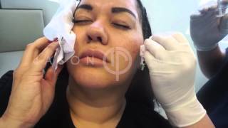 Radiesse Soft Tissue Filler Cheek Augmentation  Filler to Cheeks  Non Invasive Facial Contouring [upl. by Leanna249]