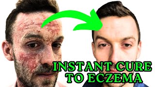 The Best amp Most Effective Remedy for Eczema [upl. by Loseff122]