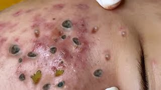 Big Cystic Acne Blackheads Extraction Blackheads amp Milia Whiteheads Removal Pimple Popping [upl. by Alleinad]