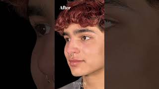 Before and After Non Surgical Nose Job nonsurgicalrhinoplasty [upl. by Nnaik564]