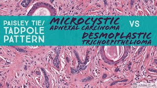 Microcystic Adnexal Carcinoma vs Desmoplastic Trichoepithelioma Paisley TieTadpole Pattern [upl. by Storfer333]