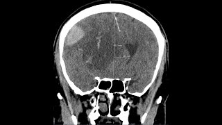 Brain herniation  subphalcine  due to intracranial haemorrhage CT findings [upl. by Neryt]