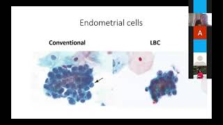 “PAP SMEAR  BENIGN CELLULAR CHANGES” by Dr Sharada Rai [upl. by Nagiam152]