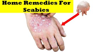 ✅scabies home remedy for scabies what is scabies  scabies symptoms how to get rid of scabies [upl. by Bouley]