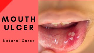 Natural Home Cures for Mouth Ulcers cankers or aphthous [upl. by Gati]