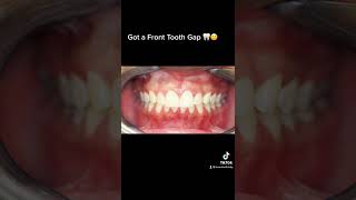 Houston Cosmetic Dentist  1 Hour 1 Visit Cosmetic Bonding to Close that Front Tooth Gap [upl. by Wiedmann]