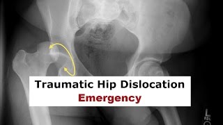 Traumatic Hip Dislocation Emergency [upl. by Gnuoy]