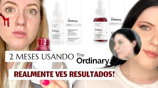 THE ORDINARYResultados reales usando AHA30BHA2 Y NIACINAMIDA por 2 MESES I Jaasa [upl. by Resiak]