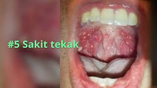 Apakah Itu Penyakit Hand Foot Mouth HFMD [upl. by Nerat]