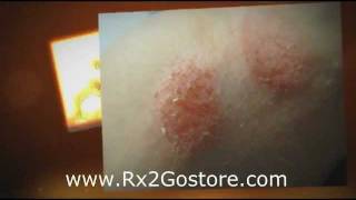 Clobetasol Cream  How to Treat Psoriasis and Eczema [upl. by Subir]