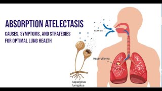 Absorption Atelectasis Unveiled  Causes Effects and More [upl. by Arita]