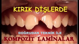 Kırık Ön Dişlerde Kompozit Laminalar 2 [upl. by Noek97]