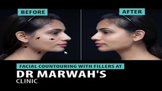 Facial Contouring with Fillers at Dr Marwahs Clinic [upl. by Sholem]