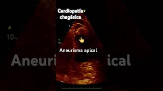 Aneurisma apical echocardiogram chagas echobynaru [upl. by Forland]