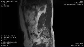 CASE 937 MRI LUMBAR SHMORLE NODE HAEMANGIOMA DISC LESION [upl. by Obau]