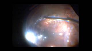 Vitrectomy for Retinal Detachment  PVR  Retinectomy  Dr Manish Nagpal [upl. by Urana101]