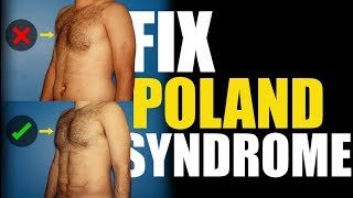 What is Poland Syndrome in Men [upl. by Correy]