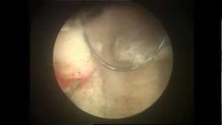 TURBT  TURP Cancer Prostate Surgery Video [upl. by Saerdna212]