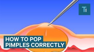 HOW TO TREAT FOLLICULITIS FAST [upl. by Venditti270]