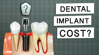 Full Arch Dental Implant Surgery Options amp Costs [upl. by Sola]