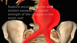 Ruptured Abdominal Aortic Aneurysm [upl. by Gilpin164]