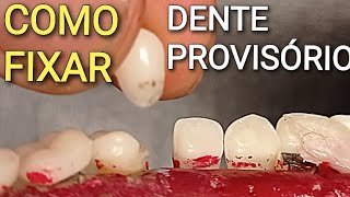 COMO FIXAR UM DENTE PROVISÓRIO  FAÇA VOCÊ MESMO [upl. by Valle]