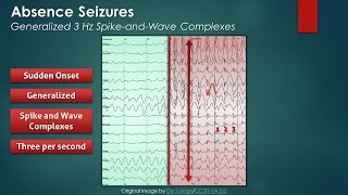 Absence Seizures EEG Findings [upl. by Hun]