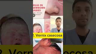 milia and vernix casecosa and lanugo shorts nursingeducation [upl. by Harutak]