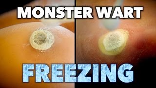 2 MONSTER WARTS vs 1 MOTHER amp SON Frozen With Liquid Nitrogen  Dr Paul [upl. by Aivilys959]