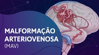 Malformação Arteriovenosa [upl. by Pachston376]