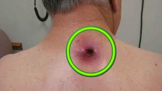 Cease and DeCyst 14 Minutes of Cyst Removal with Dr Gilmore [upl. by Comfort]