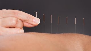 The Science Behind How Acupuncture Helps Relieve Pain A Doctor Of Chinese Medicine Explains [upl. by Airol]