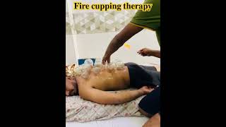 Fire cupping therapy medical shorts [upl. by Gerlac424]