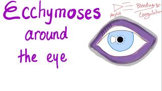 Ecchymoses around the eye [upl. by Murvyn]