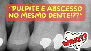 PULPITE IRREVERSÍVEL E ABSCESSO DO CANAL NO MESMO DENTE CASO RARO O QUE FAZER  Endolovers [upl. by Aseena]