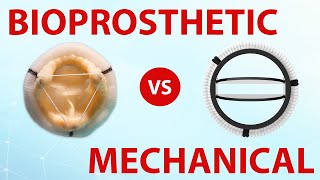 Mechanical or Bioprosthetic Heart Valves Which Is Best For You [upl. by Lyrrad]