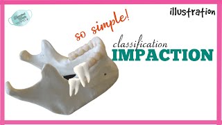 CLASSIFICATION OF IMPACTED TOOTH  IMPACTION [upl. by Hanforrd]